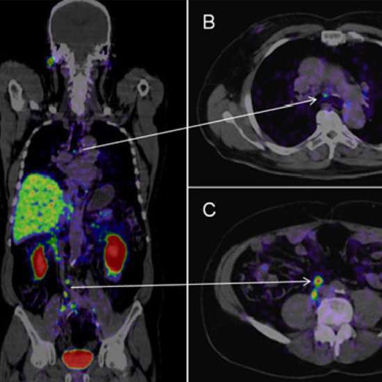 PSMA PET Scan - Purpose, Preparation & Complete Procedure